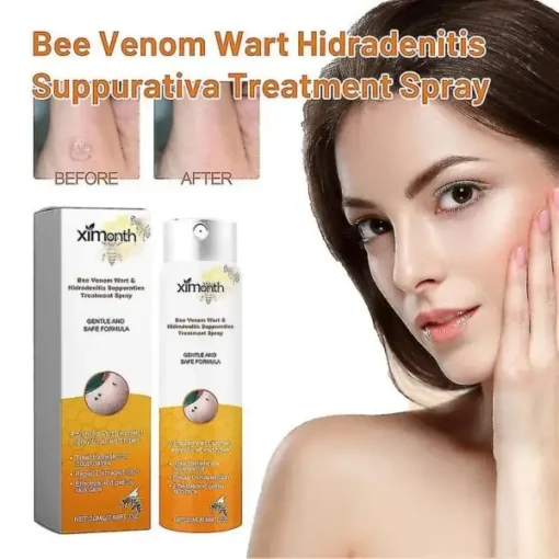 Bee Venom Wart Hidradenitis Suppurativa Treatment Spray