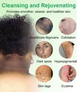 Jorondy™ Purifying Exfoliating Gel for Acanthosis Nigricans