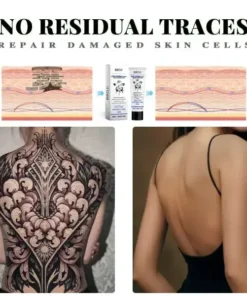 Tattoo Removal Cream - Fast Painless & Scar-Free Tattoo Erasure