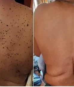 Vsoxa™ Bee Venom Wart & Moles Removal Cream